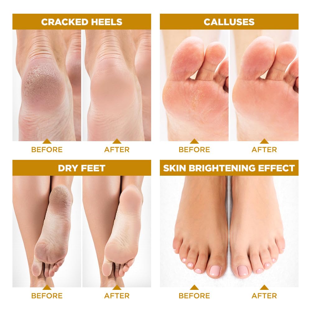 Lavinso Honey Feet Peeling Mask for Dry Cracked Feet - 2 Pack - with Kojic Acid Skin Brightening Effect - Exfoliating Dead Skin and Calluses - Foot Peel Mask for Baby Soft Feet