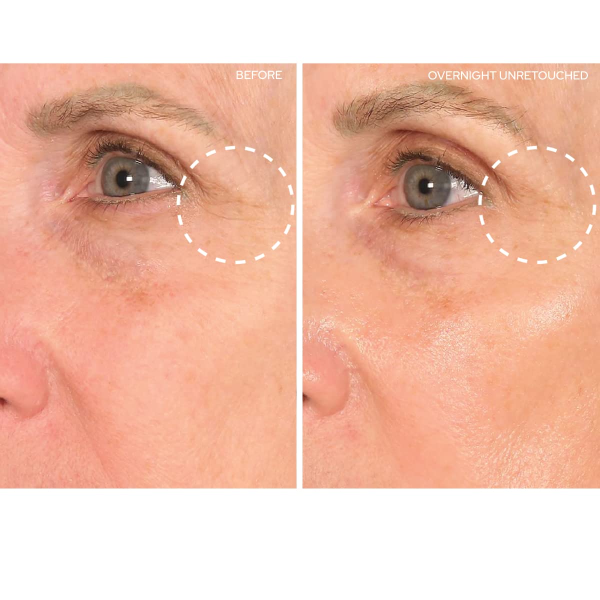 SiO Beauty SuperLift Forehead, Eye, & Lip Anti-Wrinkle Silicone Patches - Reduce Brow, Smile, and Under Eye Wrinkles Overnight