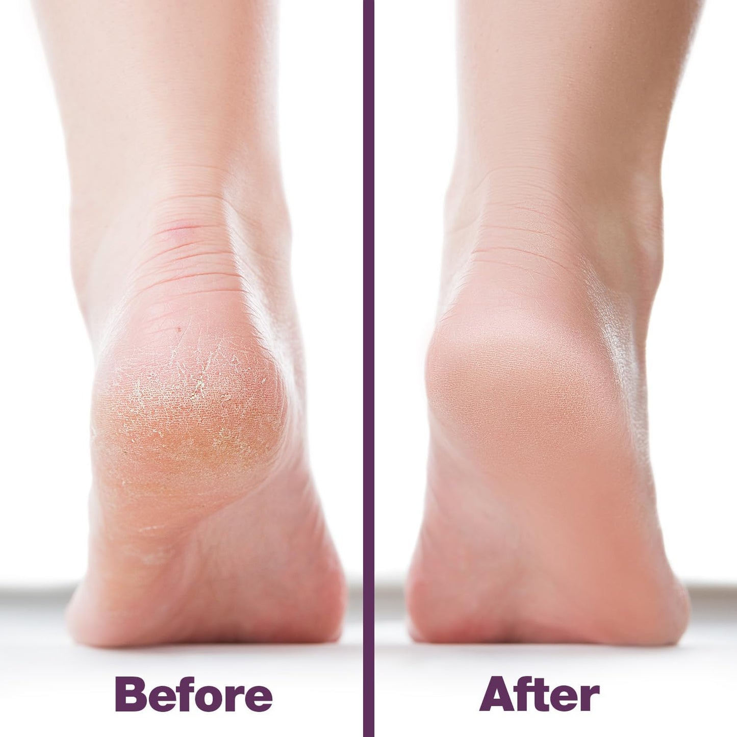 Probelle Double Sided Multidirectional Nickel Foot File Callus Remover - Immediately Reduces calluses and Corns to Powder for Instant Results, Safe Tool (Purple)