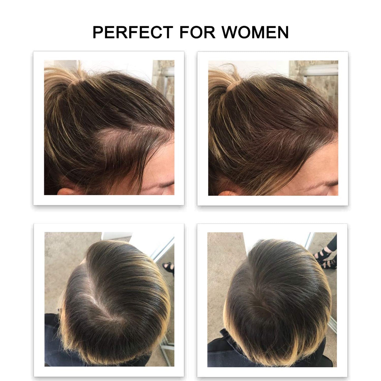FEBRON Hair Fibers For Thinning Hair For Women & Men Hair Loss Concealer Hair Powder Volumizing Based 100% Undetectable & Natural - Bald Spots Filler (30 Gram, Dark Gray)