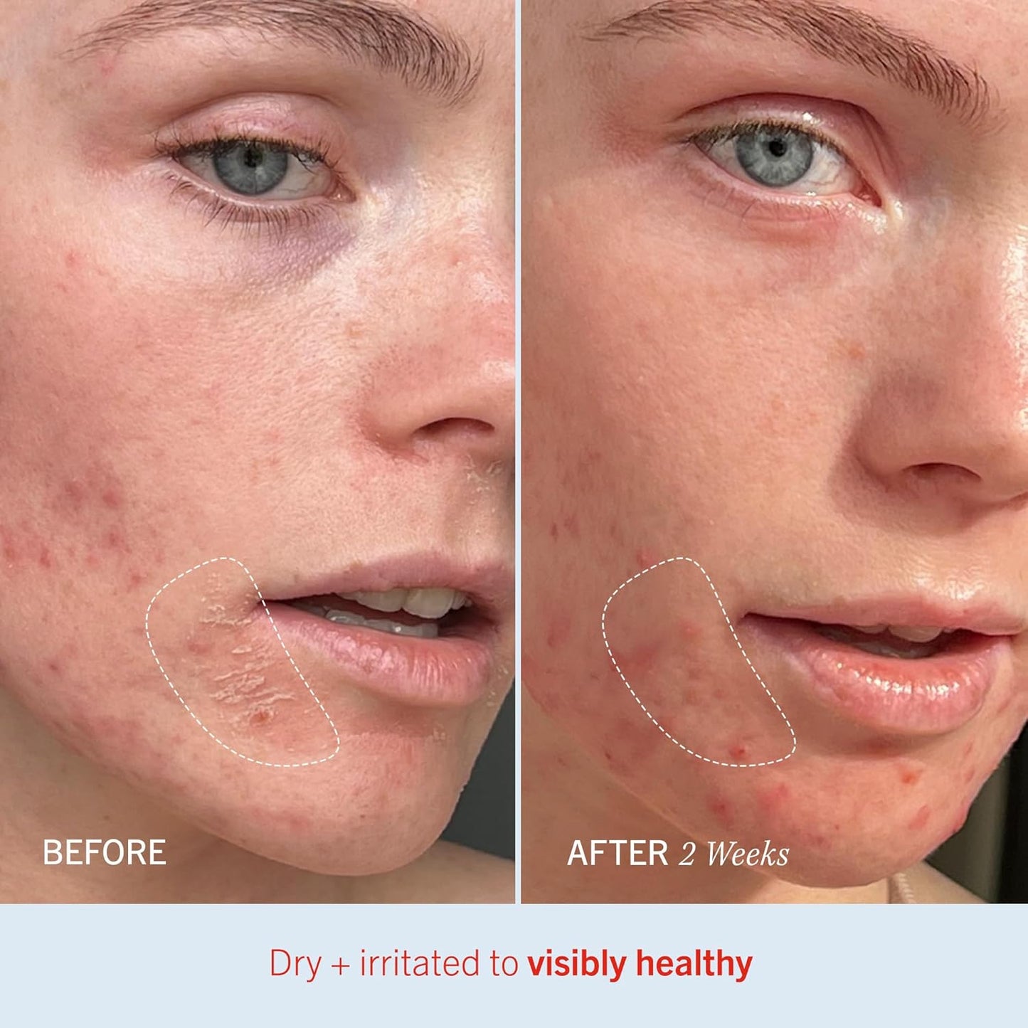 First Aid Beauty - Ultra Repair Cream, Intense Hydration Whipped Colloidal Oatmeal, Clinically Proven to Strengthen Skin Barrier in 7 Days & Helps Relieve Eczema, Luxury Face & Body Moisturizer, 6 oz